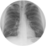 X-Ray of tuberculosis at Southern 7 Health Department